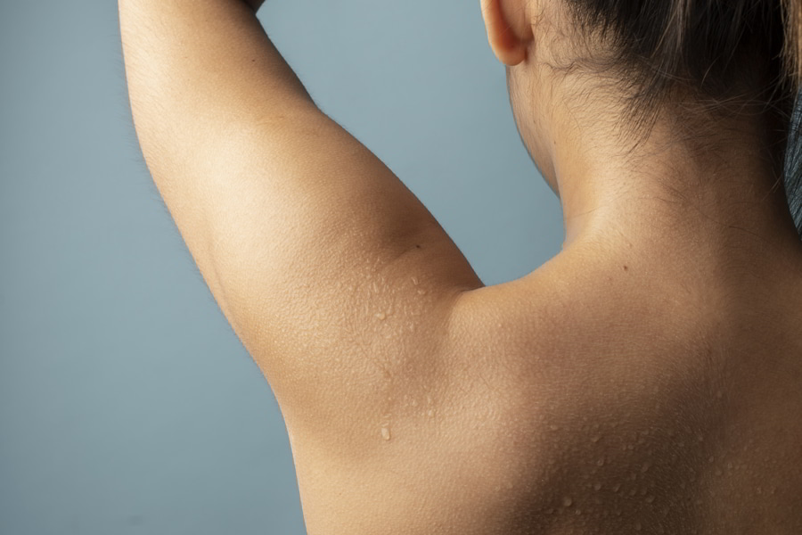 ¿Qué es la hiperhidrosis?