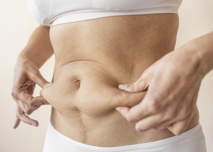 Tratamiento contra la Flacidez Abdominal