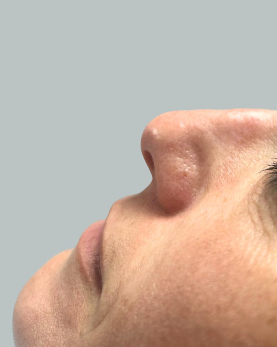 ¿Qué es la rinomodelación con ácido hialurónico?