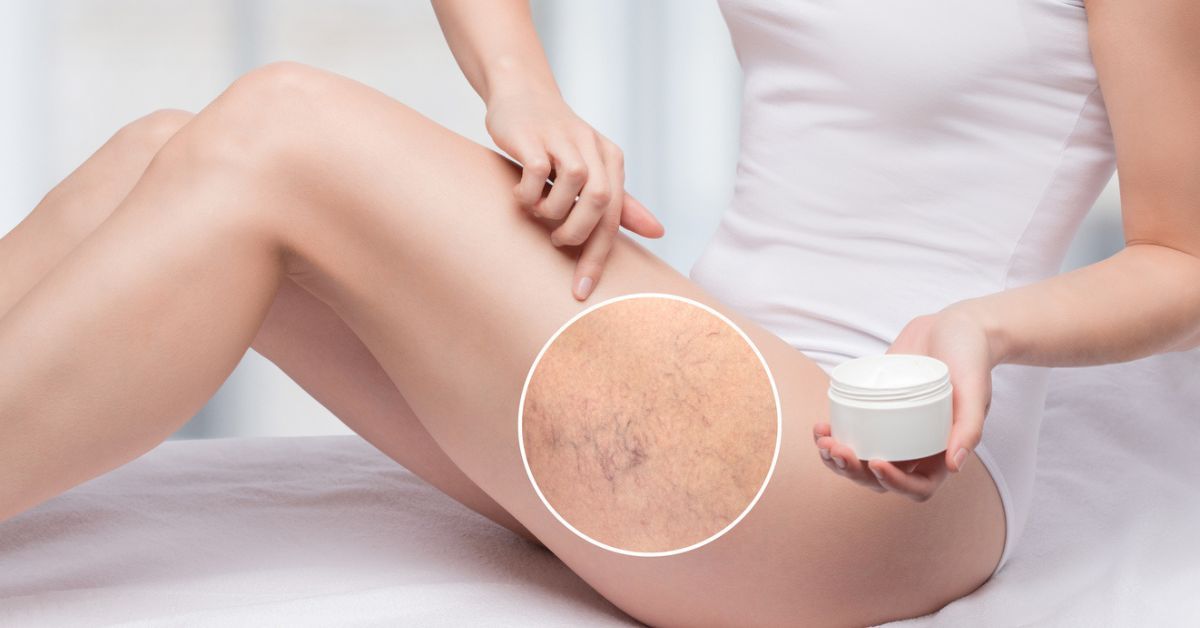 Tratamiento de lesiones vasculares