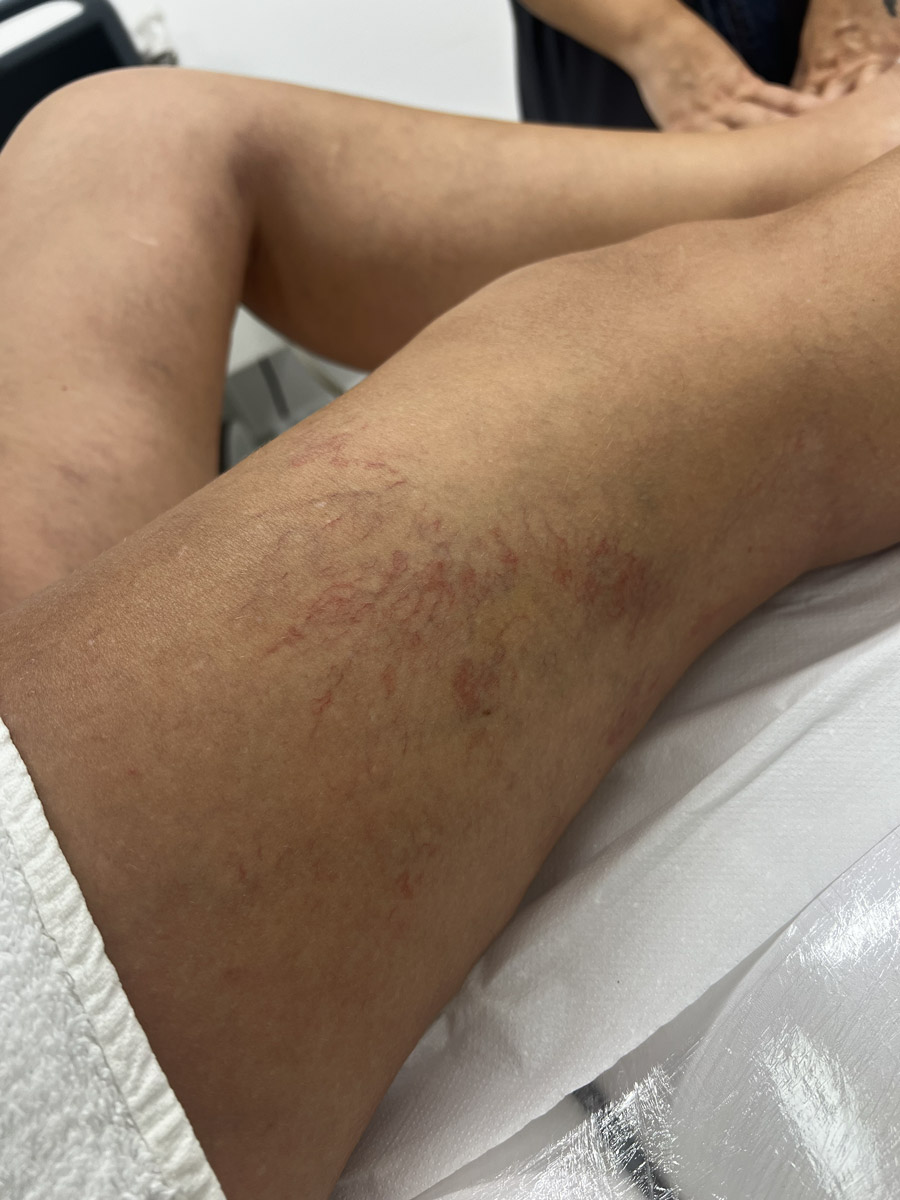 ¿Qué son las lesiones vasculares y por qué aparece?