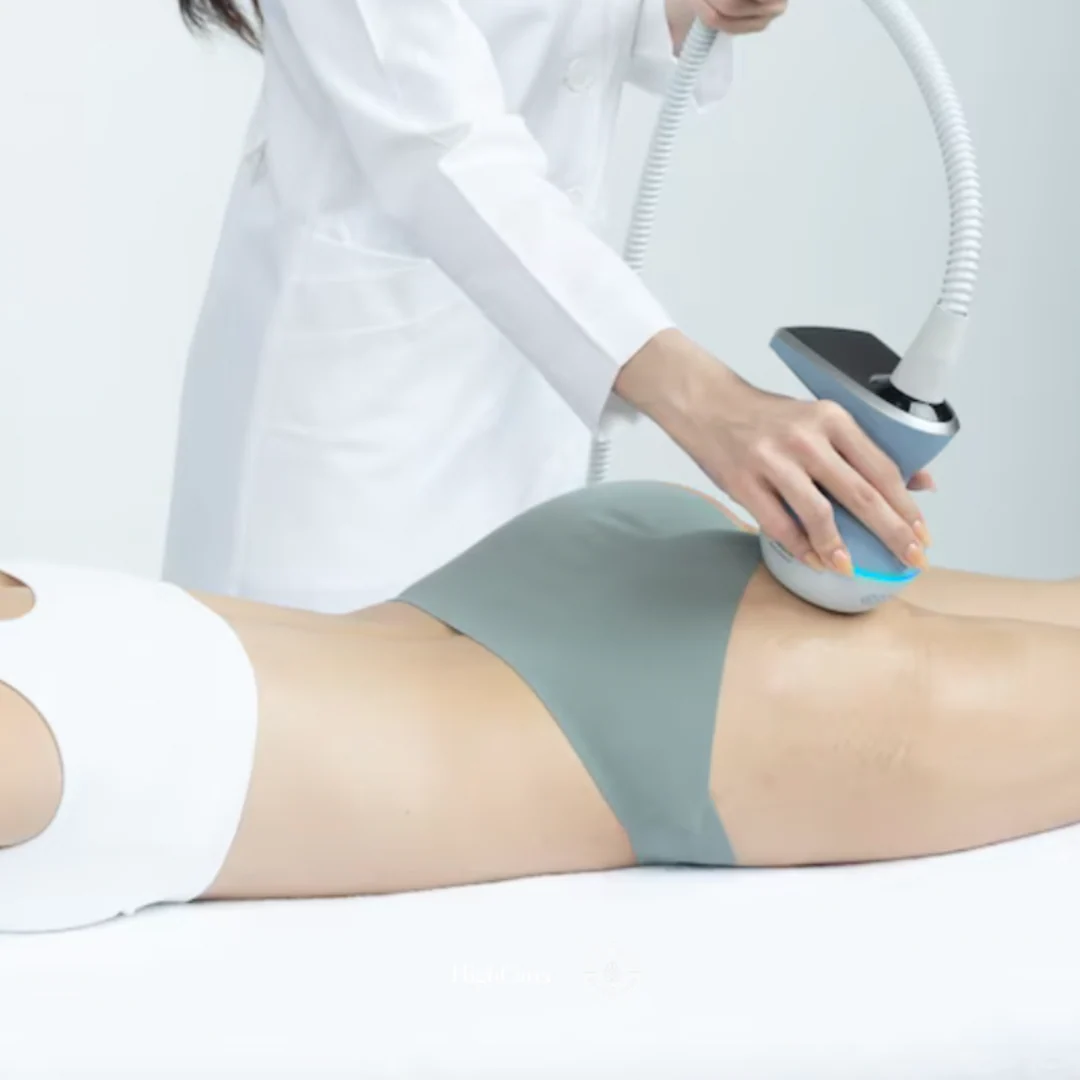 Radiofrecuencia con microagujas EXION corporales