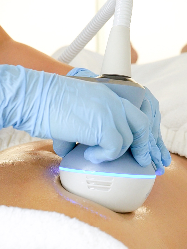 ¿Qué es la radiofrecuencia con microagujas EXION BTL?