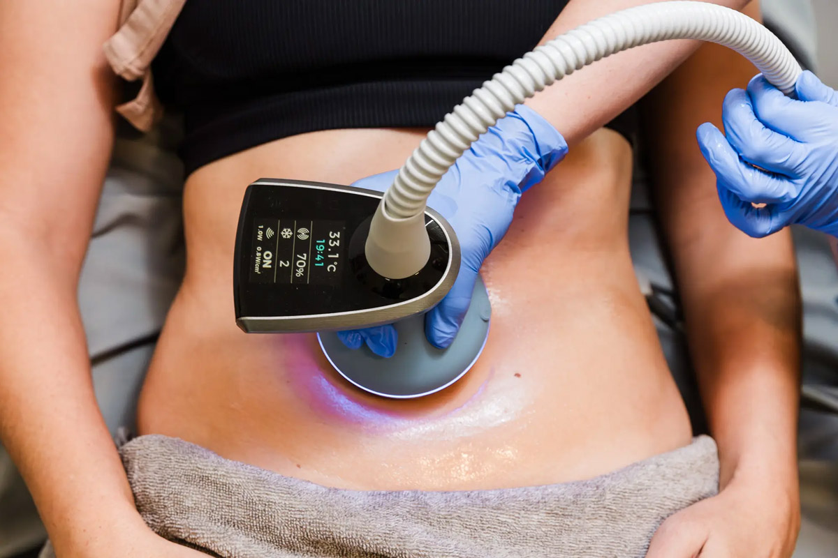 Radiofrecuencia con microagujas EXION en Huelva 