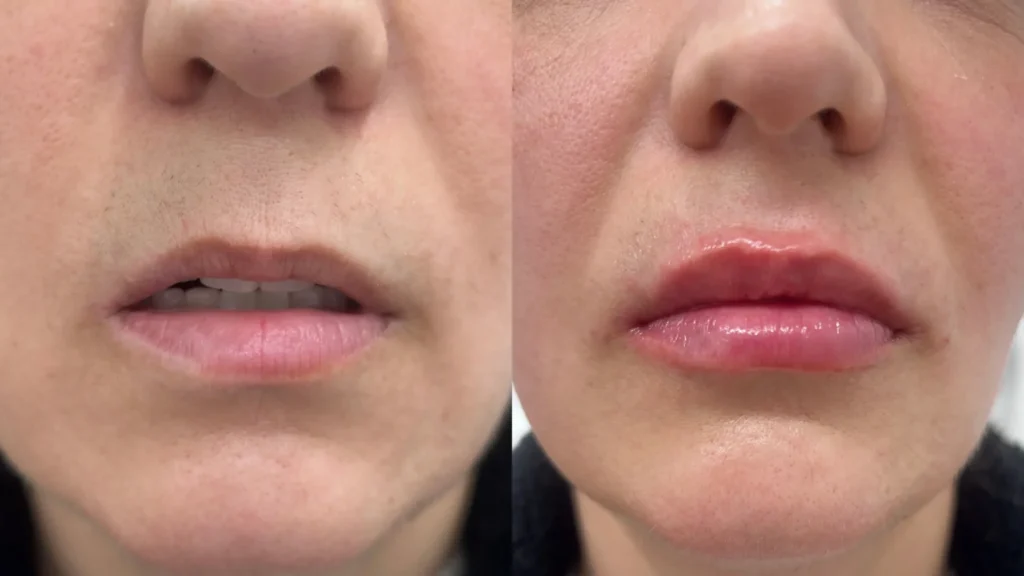 Aumento y armonización de labios con ácido hialurónico