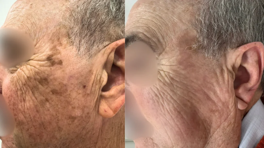 Mejora de la pigmentación facial