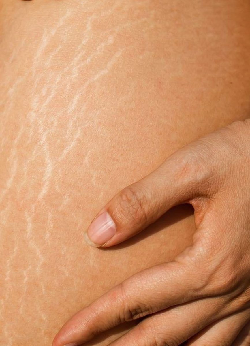 Importancia de la hidratación intensiva tras el láser