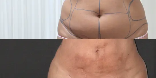 Liposucción con Lipolaser