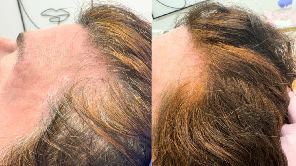 Tratamiento capilar: mesoterapia, PRP y tratamiento médico