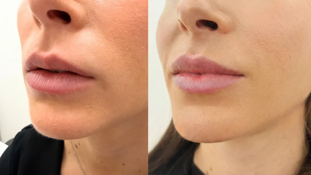 Tratamiento de labios