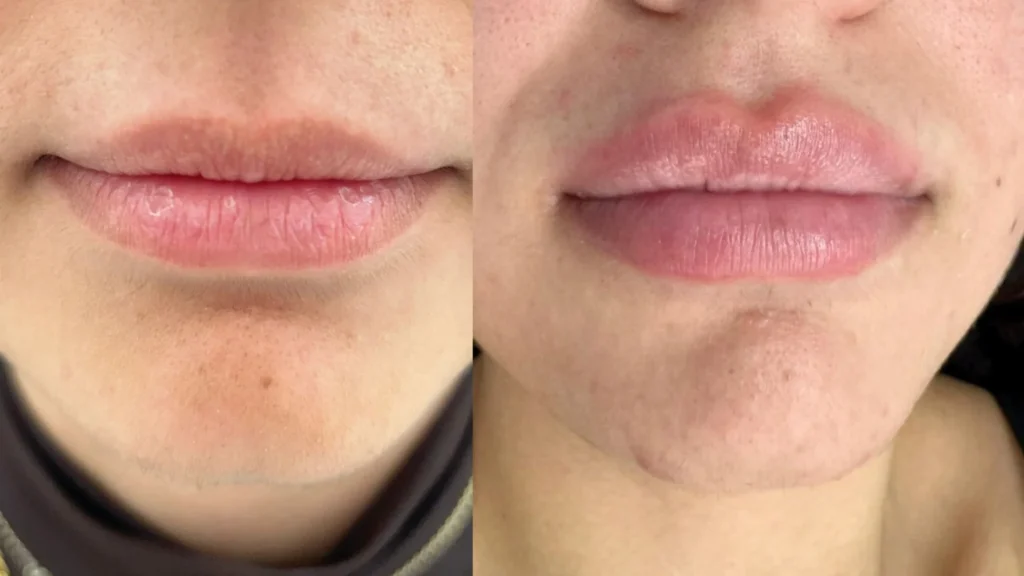 Aumento de labios con ácido hialurónico