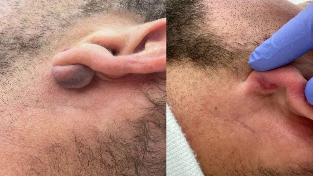 Cirugía dermatológica con láser CO2