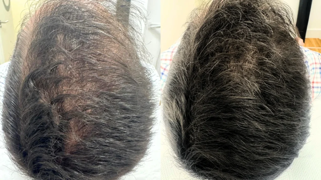 Tratamiento capilar con mesoterapia, centrifugado y tratamiento médico