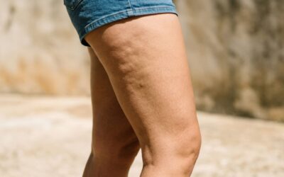 Celulitis y flacidez en verano: tratamientos corporales sin cirugía