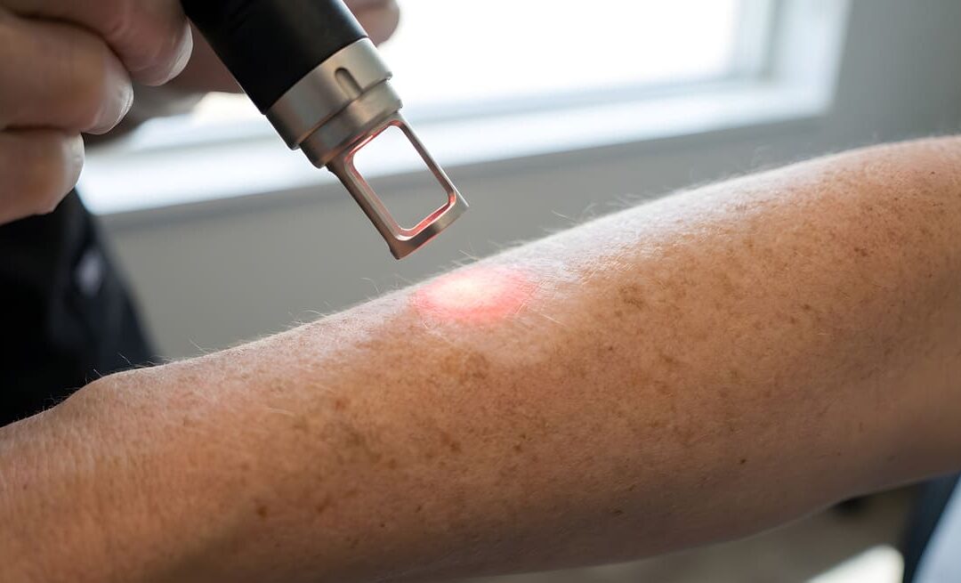 Manchas solares en la piel