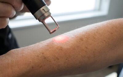 Manchas solares en la piel: cómo prevenirlas y qué tratamientos existen