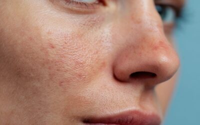 Tratamientos estéticos recomendados después del verano: qué hacer y qué evitar